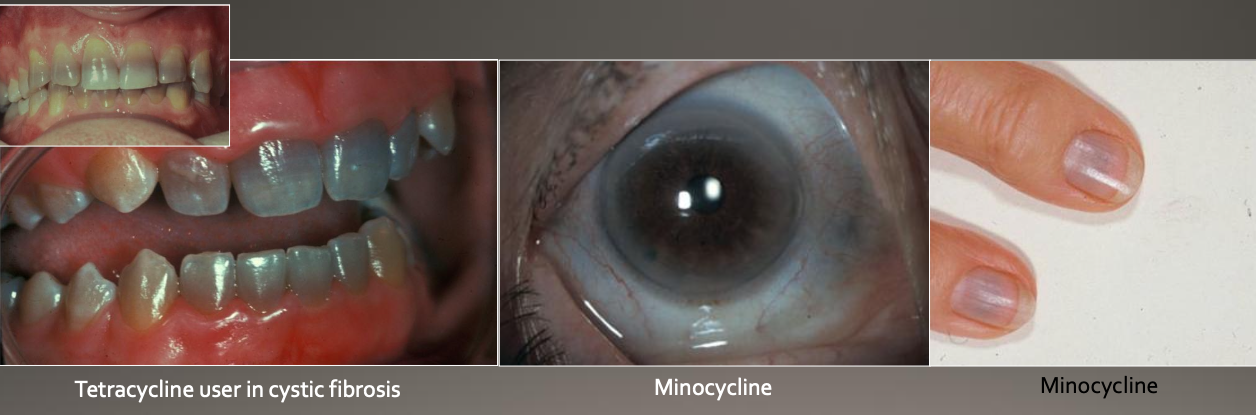 <p>From use of tetracycline during tooth development</p>