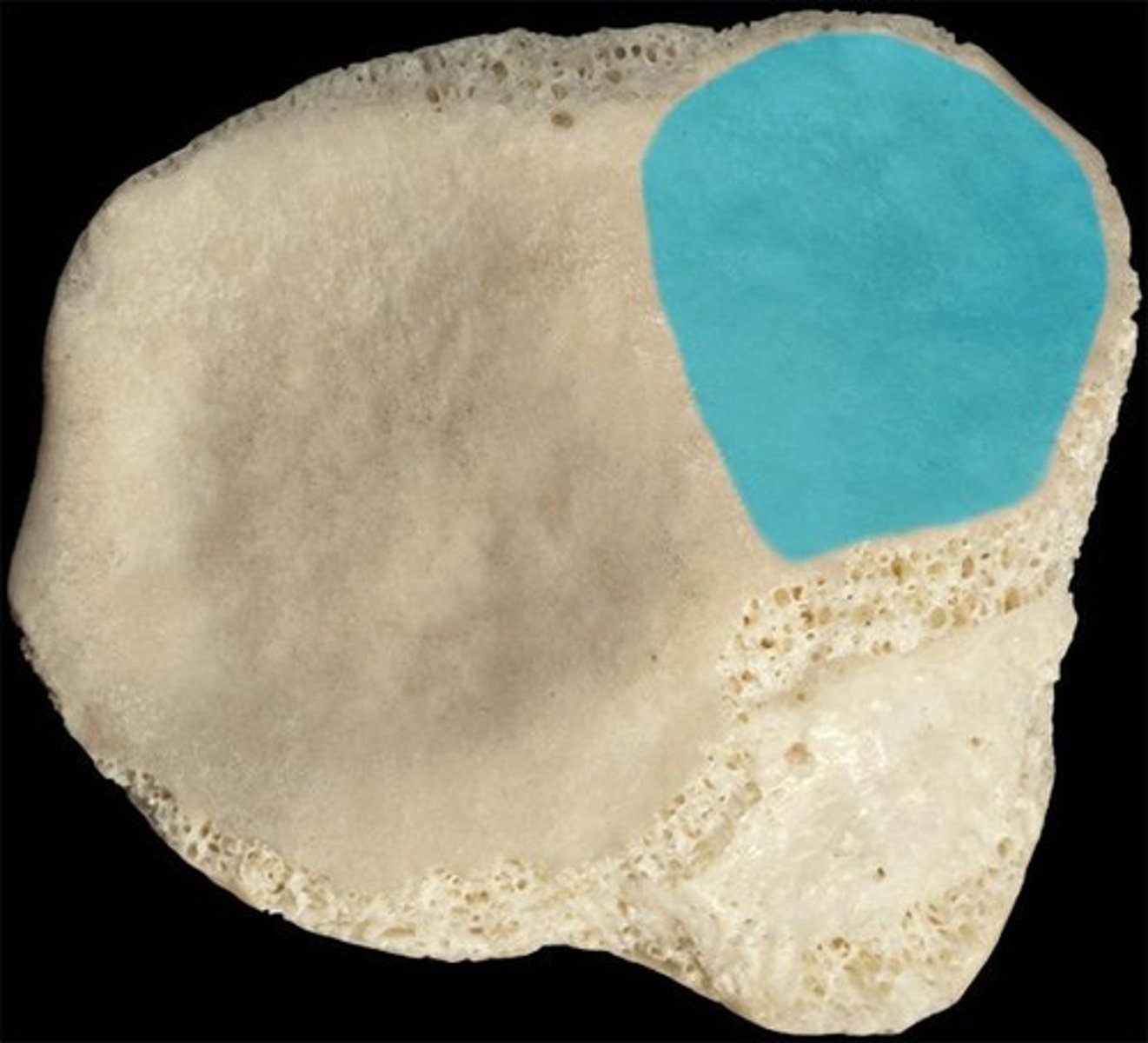 <p>for the distal FEMUR - faces posteriorly and is smaller than the lateral articular facet</p>