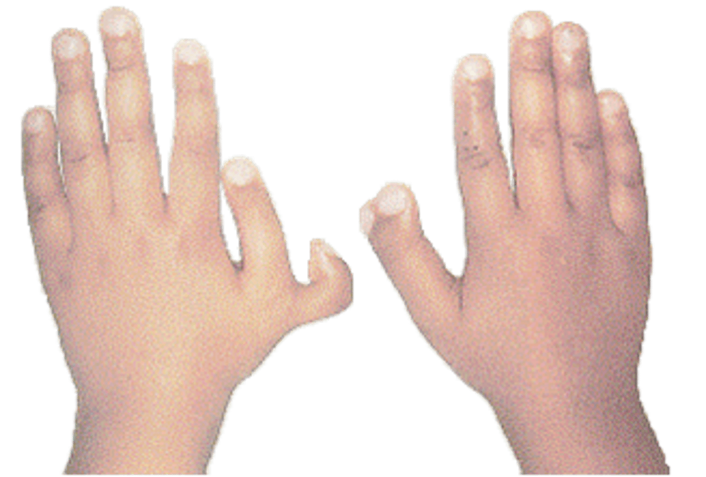 <p>Polydactyly</p>