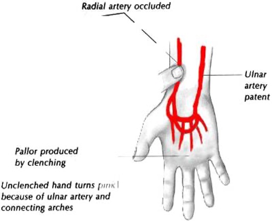 <ul><li><p><strong>arterial compromise- </strong>assess hand circulation</p></li><li><p>rapidly open and close hand 15 times → place thumbs over radial and ulnar arteries → have pt open hand; should be pale → release one artery and hand should flush </p></li><li><p>positive = hand remains cyanotic </p></li></ul><p></p>