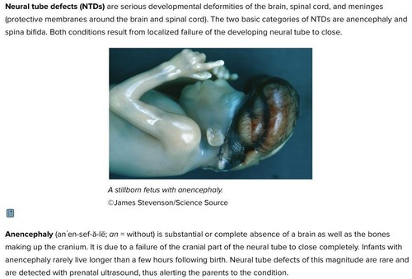 <p>Neural tube defects such as Anencephaly or Spina bifida may occur.</p>