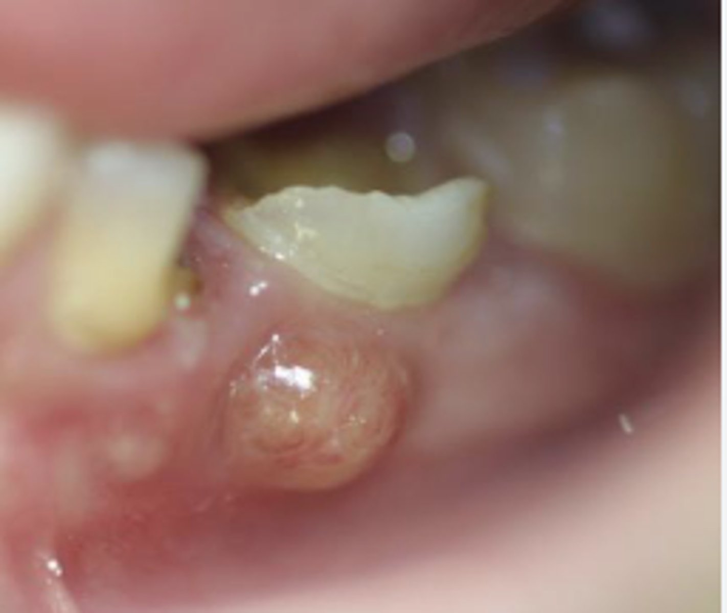 <p>-localized infection at the root of a tooth or in the surrounding gum tissue</p><p>-progression of untreated infections (dental caries or periodontal disease) that have extended to deeper tissues, resulting in pus formation</p><p>-<strong>Anaerobic bacteria</strong> are often implicated in abscesses, similar to periodontitis.</p>