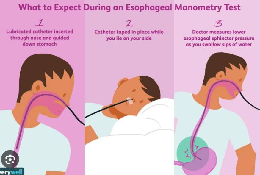 <p>It is used to evaluate esophageal contractions and esophageal sphincter pressures. Pressures are measured by pressure transducers on a tube inserted orally.</p>