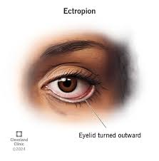 <p>PP/E: lower lid margin turns outward→exposes palpebral conjunctiva→affected eye drainage→tearing</p><p>E: elderly<br>older adults</p><p>CM: lower eyelid rolled out→red inside showing<br>teary eyes</p>