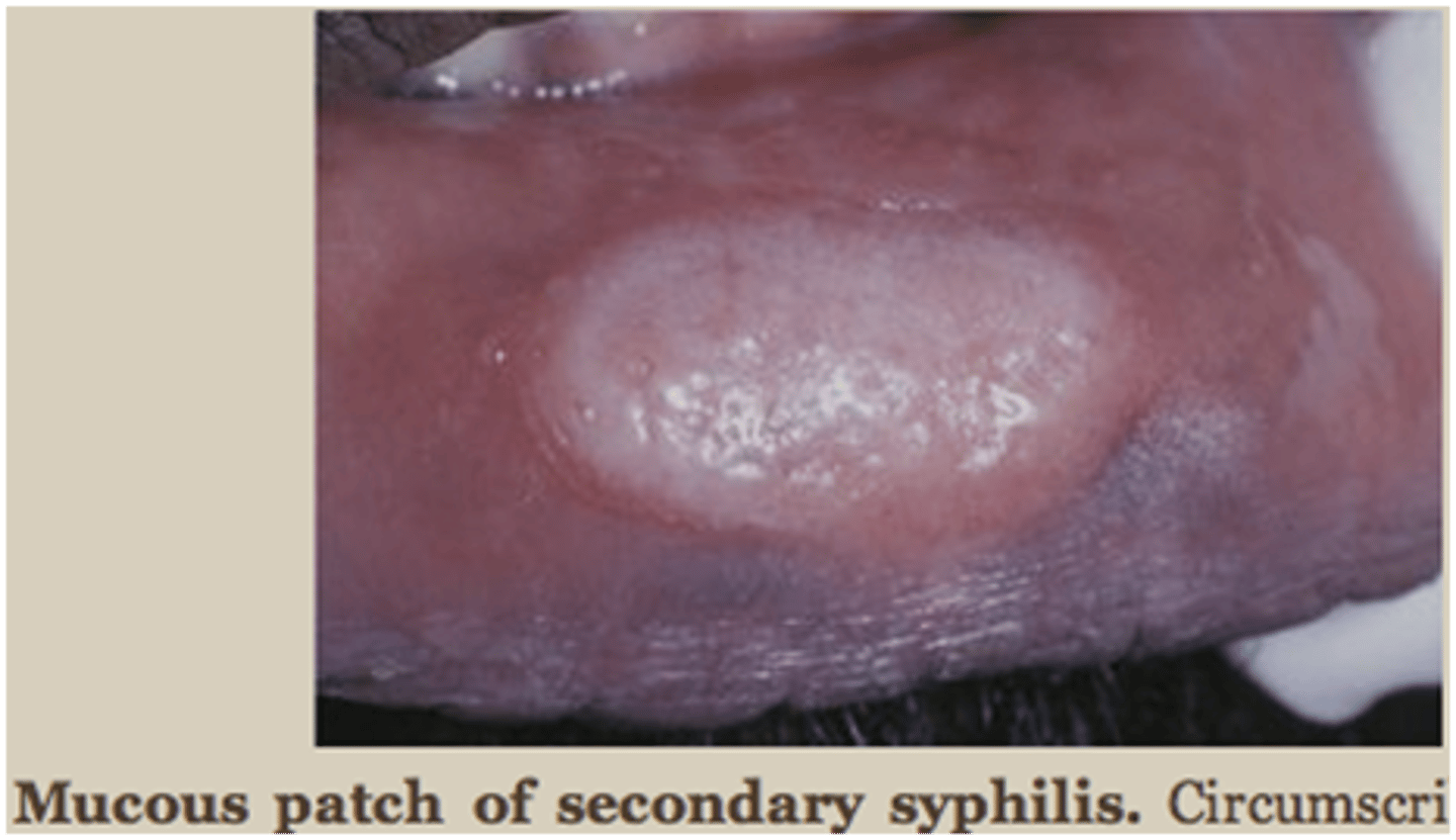 <p>mucous patch</p><p>• whitish-gray plaque on mucosa</p><p>• highly contagious</p><p>• bacteria: Treponema pallidum</p>