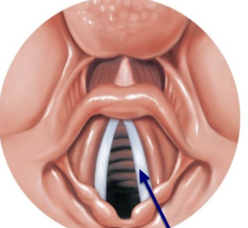 <p>False vocal cords are <span>superior to the true vocal folds</span></p>
