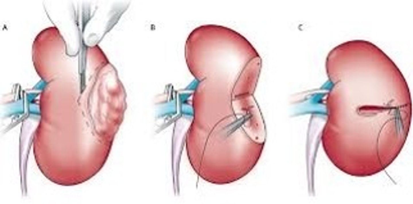 <p>Resection = best; ablation (if poor surgical candidate), active surveillance, adjuvant therapy (immunotherapy, molecularly-targeted therapy)</p>