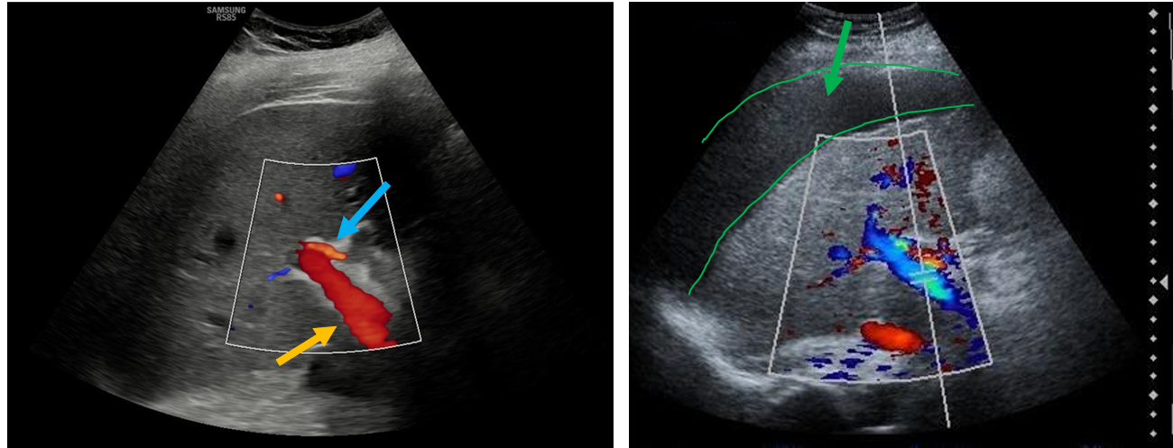 <p>Patient history: routine abdominal ultrasonography (left); years of heavy alcohol consumption, at present fatigue and enlarging abdominal circumference (right) </p><p>Modality: abdominal ultrasound, 3-5 MHz convex transducer </p><p>Region: abdomen, right upper quadrant </p><p>Radiologic sign: left image – normal hepatopetal flow in the portal vein (yellow arrow); blue arrow signs the narrower hepatic artery adjacent to portal vein; right image – reversed, hepatofugal flow in the portal vein in a liver cirrhotic patient due to increased hepatic resistance; perihepatic fluid (ascites) is also observable on the same image (green arrow and outline). </p><p>Diagnosis: reversed portal flow and ascites in liver cirrhosis</p>