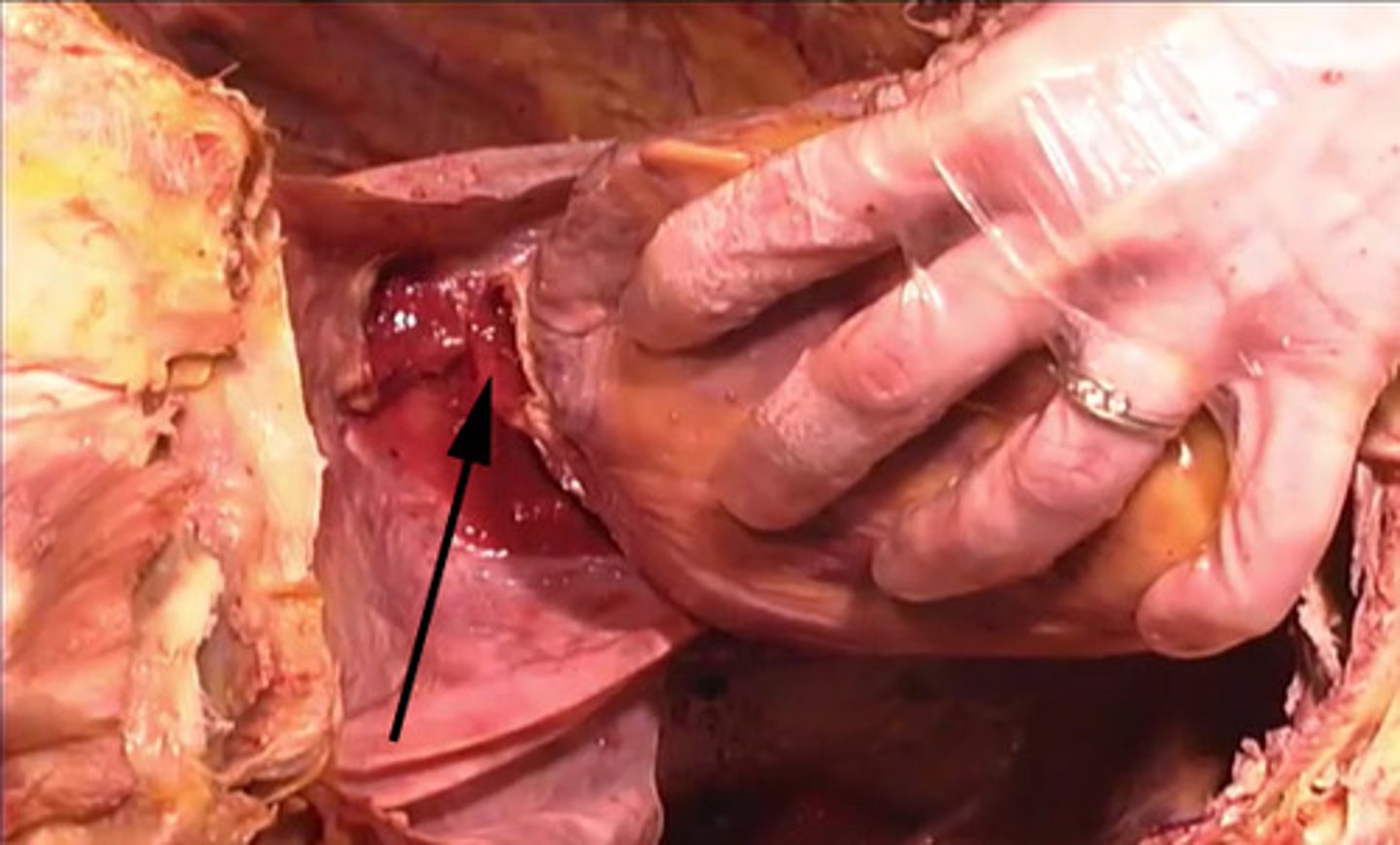 <p>To what structure is the arrow pointing?</p><p>superior vena cava</p><p>inferior vena cava</p><p>renal artery</p><p>renal vein</p>