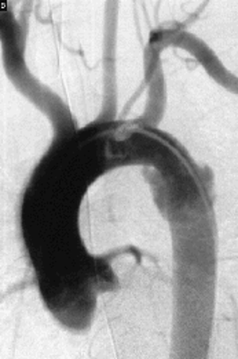 <p>radiography of the aorta</p>