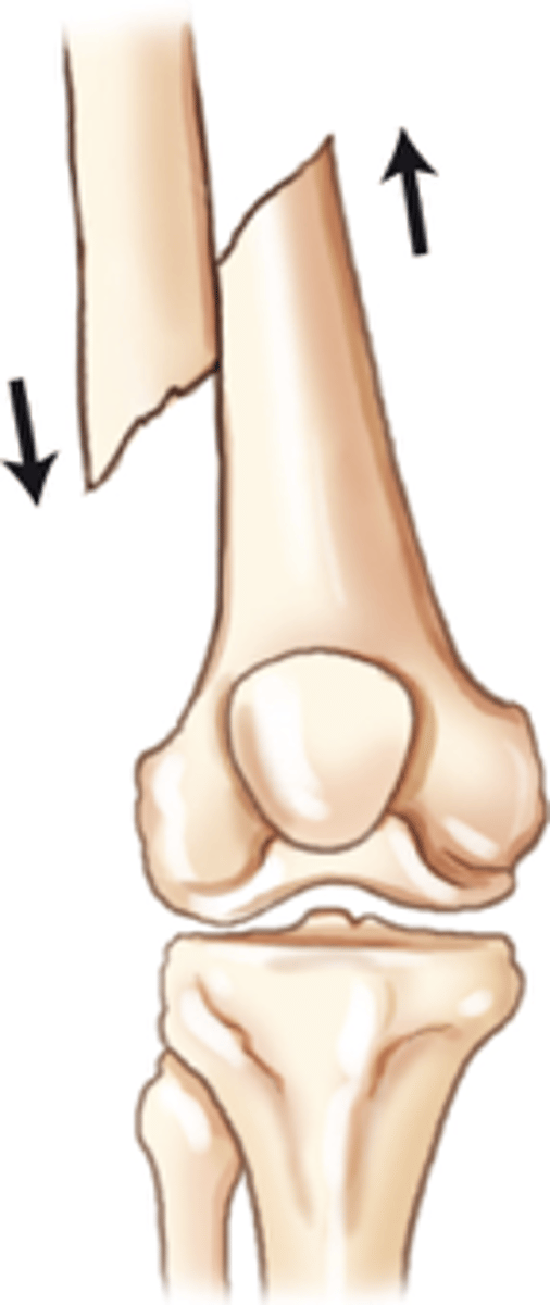 <p>A fracture wherein the fragments overlap and the shafts make contact, but not at the fracture ends</p>