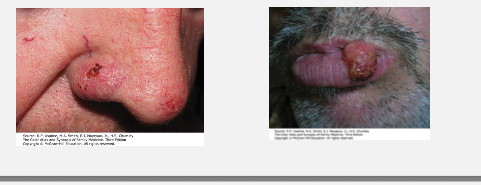 <ul><li><p><strong>Red, hard, hyperkeratotic papules, nodules, or plaques.</strong></p></li><li><p>May <strong>ulcerate.</strong></p></li><li><p>Commonly found on <strong>sun-exposed areas</strong>: <strong>ear, lip (lower lip), oral cavity, tongue, and genitalia.</strong></p></li></ul><p></p>