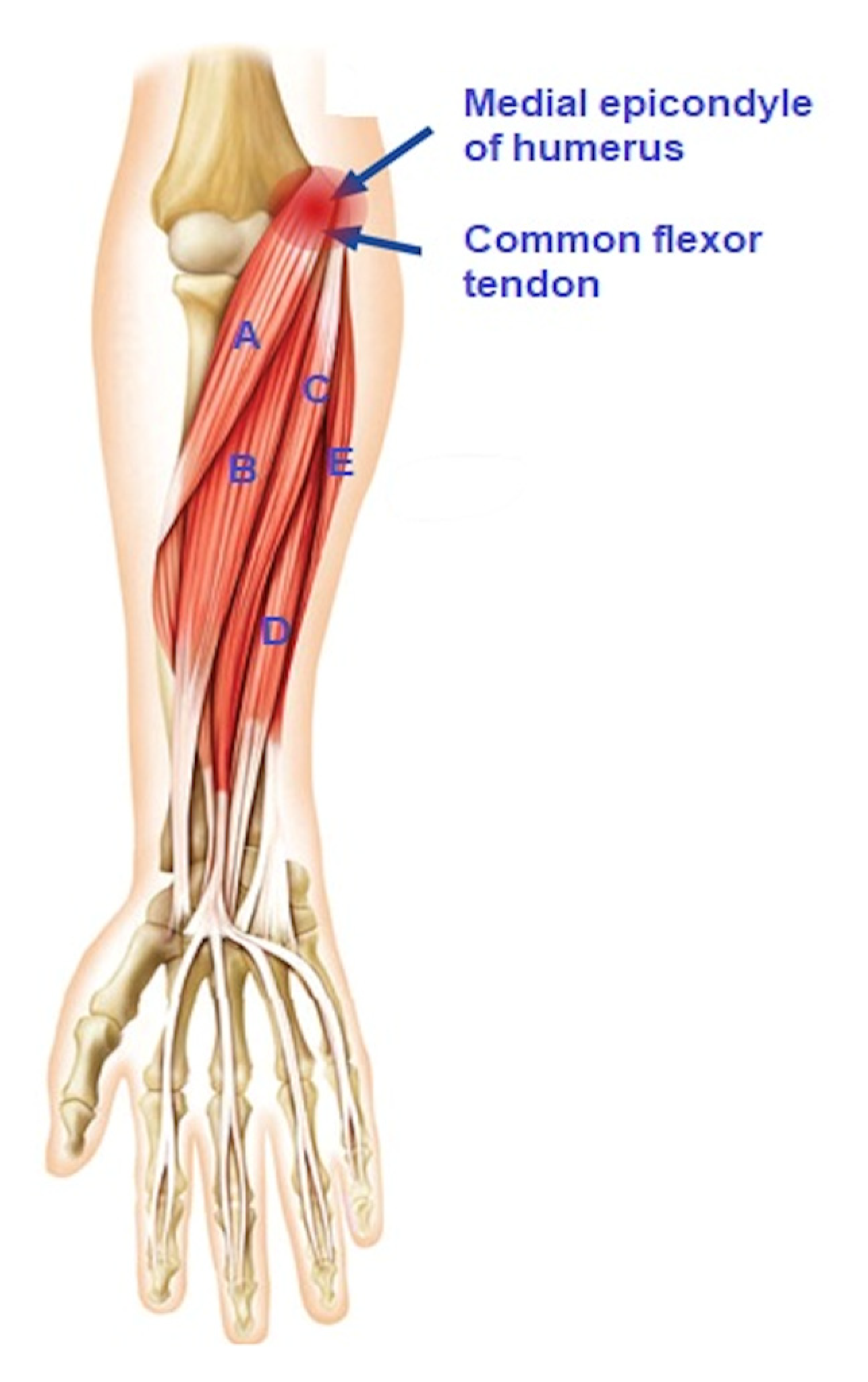 <p>From the *medial epicondyle* of the humerus via a common flexor tendon. 📍 Mnemonic: "Medial = flexor base."</p>