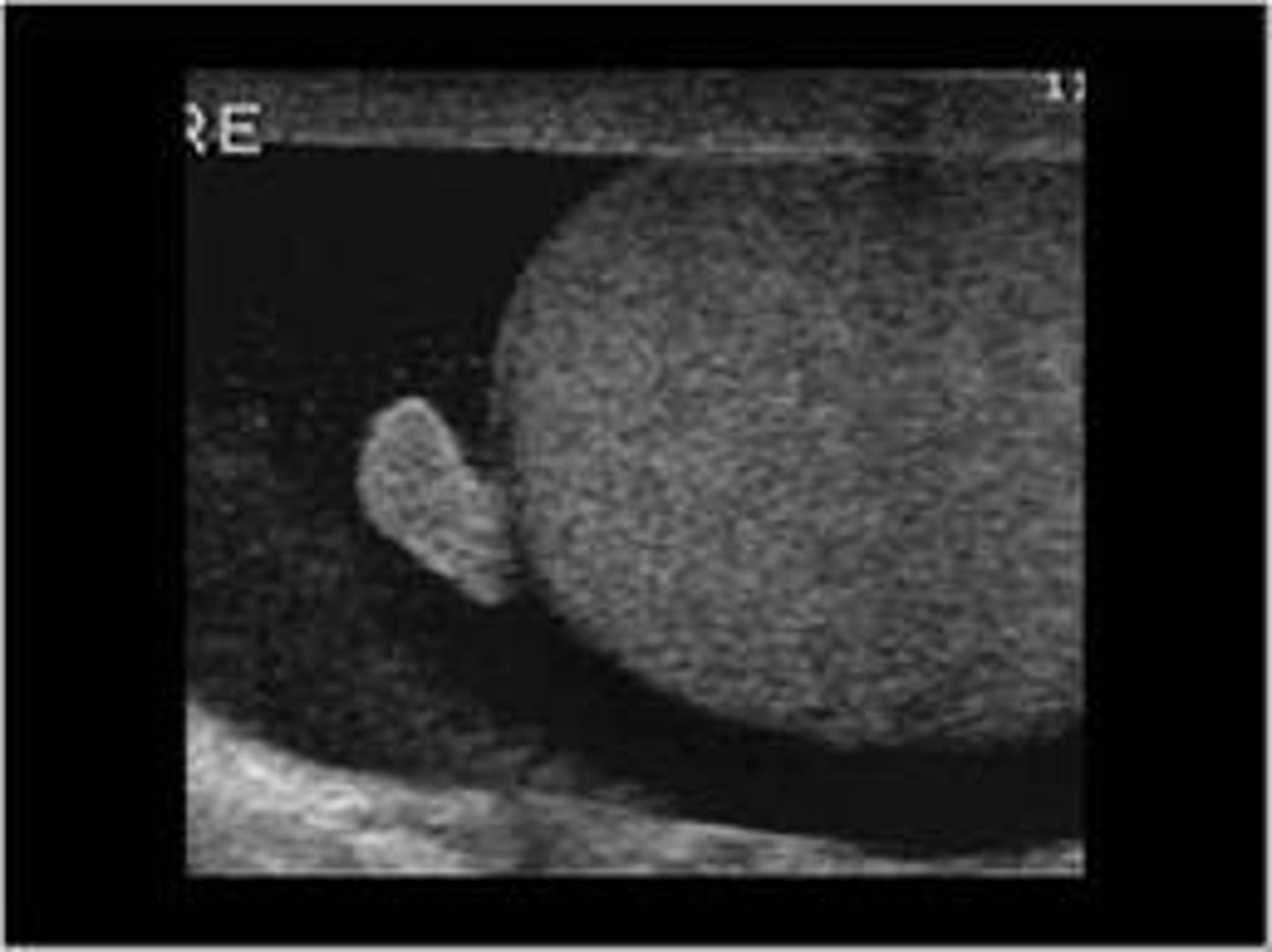 <p>b. Appendix epididymis </p>