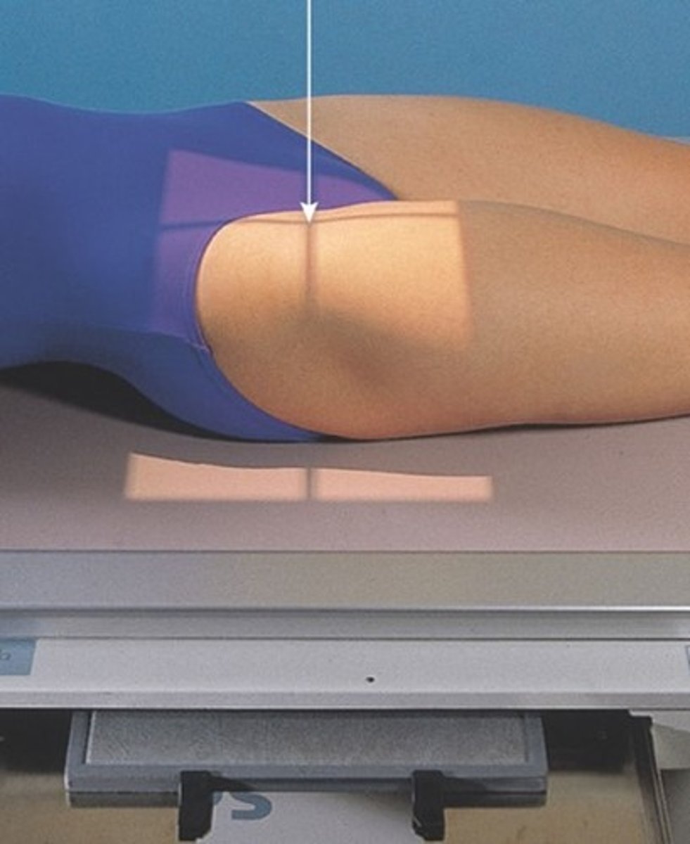 <p>perpendicular to the femoral neck (1-2 inches medial and 3-4 inches distal to ASIS)</p>