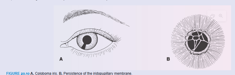 <p>Eye Abnormalities</p><p>Coloboma may occur if the choroid fissure fails to close. Normally, this fissure closes during the seventh week of development (Fig. 20.7). When it does not, a cleft persists. Although such a cleft is usually in the iris only—coloboma iridis (Fig. 20.10A)—it may extend into the ciliary body, the retina, the choroid, and the optic nerve. Coloboma is a common eye abnormality frequently associated with other eye defects. Colobomas (clefts) of the eyelids may also occur. Mutations in the PAX2 gene have been linked with optic nerve colobomas and may play a role in the other types as well. Renal defects also occur with mutations in PAX2 as part of the renal coloboma syndrome (see Chapter 16, p. 264).</p><p>The iridopupillary membrane (Fig. 20.10B) may persist instead of being resorbed during formation of the anterior chamber.</p><p>Congenital cataracts cause the lens to become opaque during intrauterine life. Although this anomaly is usually genetically determined, many children born to mothers who had rubella (German measles) between the fourth and seventh weeks of pregnancy had cataracts. If the mother is infected after the seventh week of pregnancy, the lens escapes damage, but the child may have hearing loss as a result of cochlear abnormalities. Because of the MMR (measles, mumps, and rubella) vaccine, congenital rubella syndrome has been nearly eradicated in the United States.</p><p>The hyaloid artery may persist to form a cord or cyst. Normally, the distal portion of this vessel degenerates, leaving the proximal part to form the central artery of the retina.</p><p>In microphthalmia, the eye is too small; the eyeball may be only two-thirds of its normal volume. Usually associated with other ocular abnormalities, microphthalmia can result from intrauterine infections, such as cytomegalovirus and toxoplasmosis.</p><p>Anophthalmia is absence of the eye. In some cases, histologic analysis reveals some ocular tissue. The defect is usually accompanied by severe cranial abnormalities.</p><p>Congenital aphakia (absence of the lens) and aniridia (absence of the iris; Fig. 20.11) are rare anomalies that result from disturbances in induction and development of tissues responsible for formation of these structures. Mutations in PAX6 result in aniridia and may also contribute to anophthalmia and microphthalmia.</p><p>Cyclopia (single eye) and synophthalmia (fusion of the eyes) comprise a spectrum of defects in which the eyes are partially or completely fused (Fig. 20.12). The defects are caused by a loss of midline tissue that may occur as early as days 19 to 21 of gestation or at later stages when facial development is initiated. This loss results in underdevelopment of the forebrain and frontonasal prominence. These defects are invariably associated with a brain defect called holoprosencephaly, in which the cerebral hemispheres are partially or completely merged into a single telencephalic vesicle. Factors associated with holoprosencephaly include maternal alcohol use, maternal diabetes, mutations in SHH, and abnormalities in cholesterol metabolism that may disrupt SHH signaling (see Chapter 18).</p>