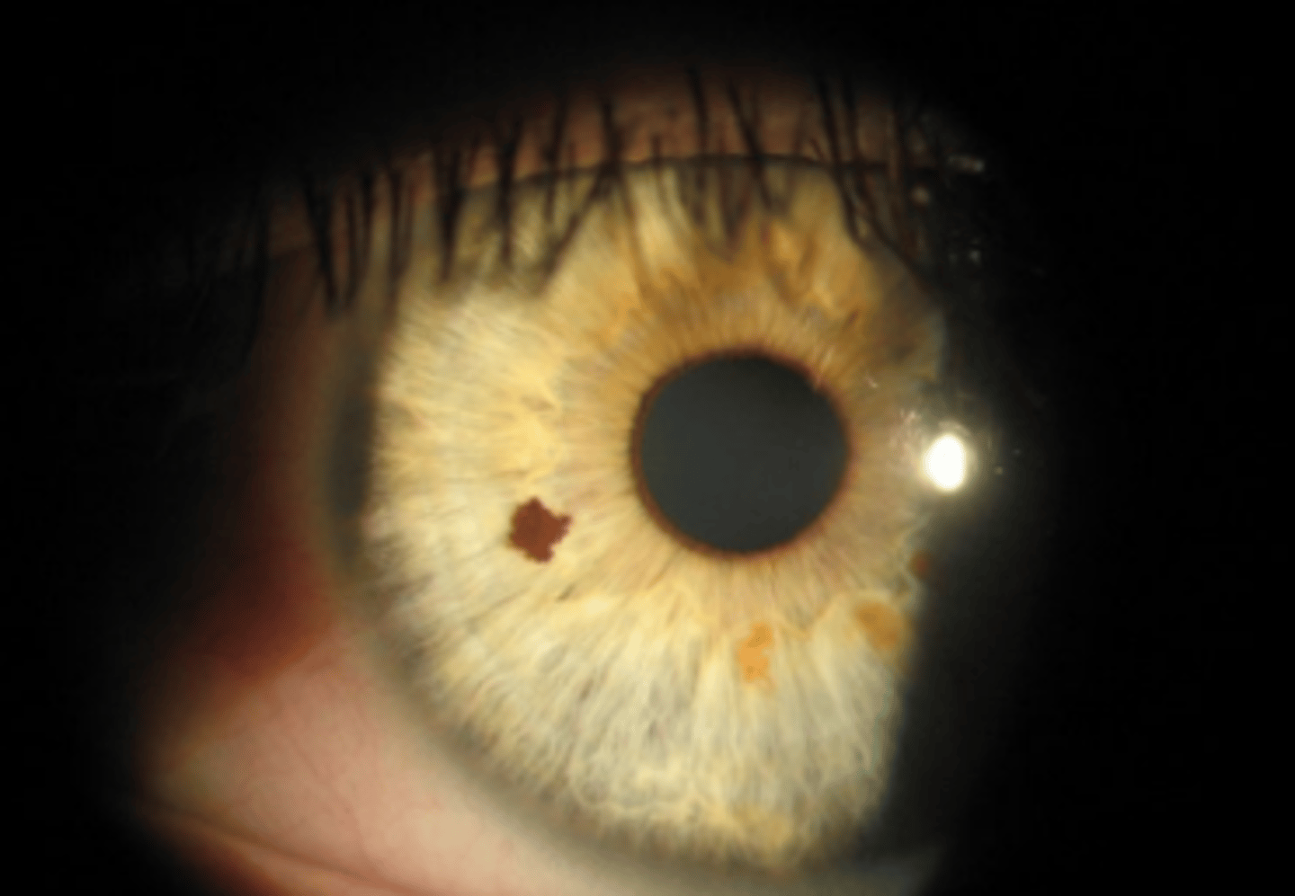 <p>very common hyperpigmentation of the iris that varies in size, shape, color. Has mild to no vascularization or pupil distortion and is less than 3 mm.</p>