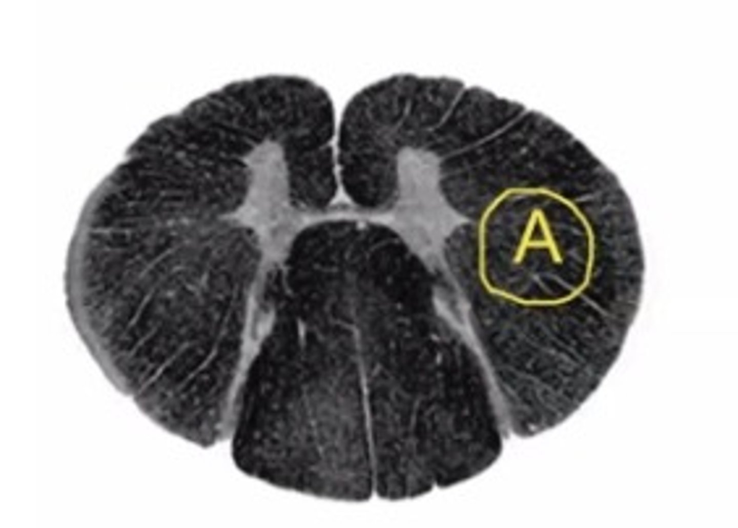 <p>Describe the signs/symptoms that you will see if structure "A" is lesioned.</p>