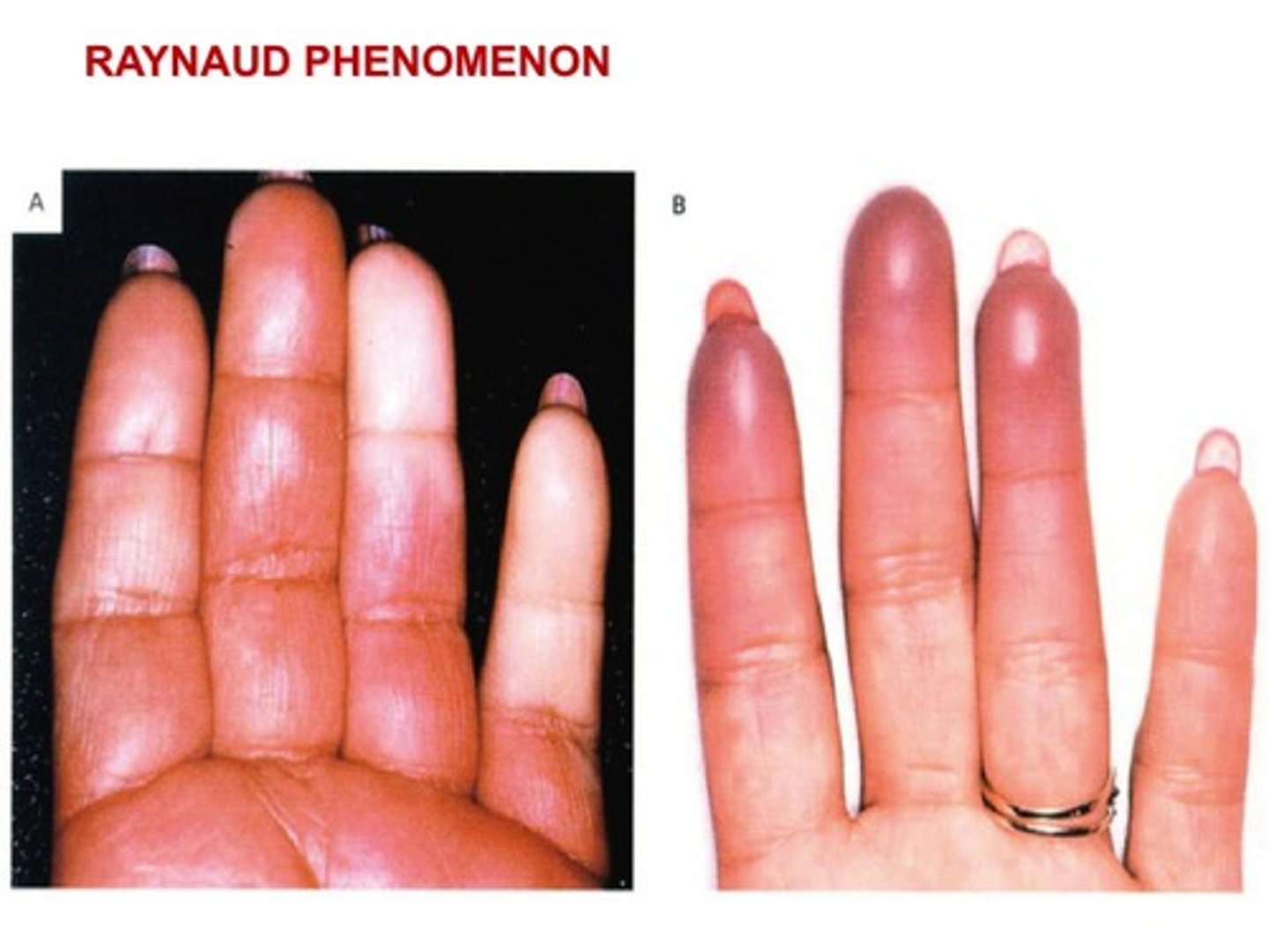 <p>Circulatory disorder</p>