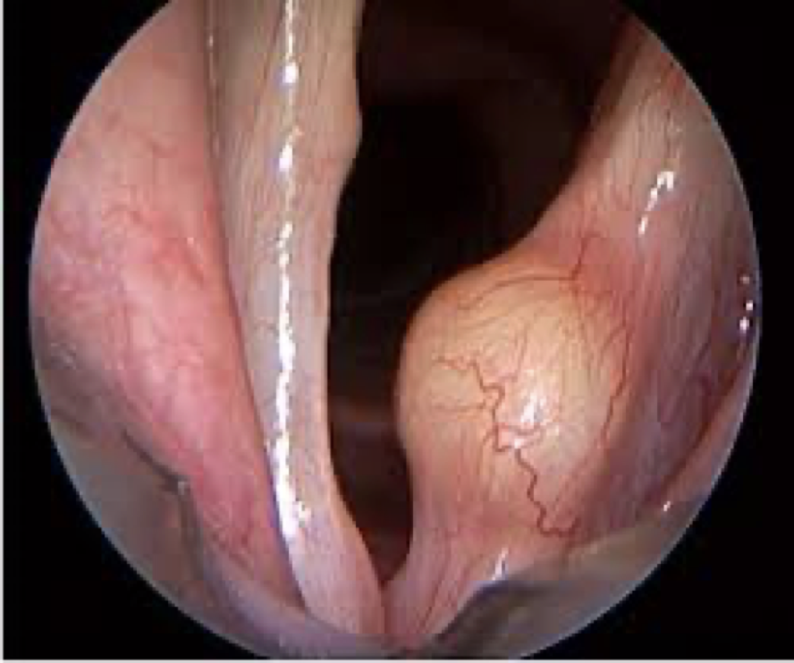 <p>blockage in the glandular duct causing retention of mucus or blood</p>