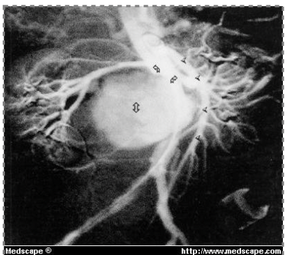 <p>This image is showing a</p>