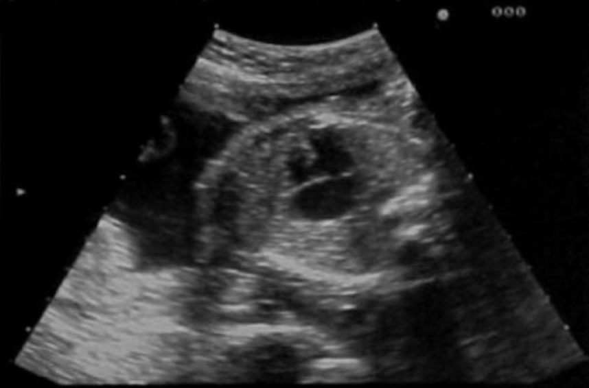 <p>a) noonan syndrome</p><p>b) potter syndrome</p><p>c) trisomy 18</p><p>d) trisomy 21</p>