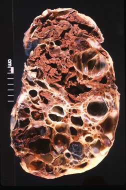 <p><span>A 65-year-old male dies of chronic renal failure. His past medical history includes hypertension, recurrent flank pain with hematuria, and mitral valve prolapse. His family history is positive for renal failure. An autopsy is performed, which reveals the lesions shown in the exhibit. </span></p><p><span>Which of the following is most strongly associated with this patient's underlying disorder? </span></p>