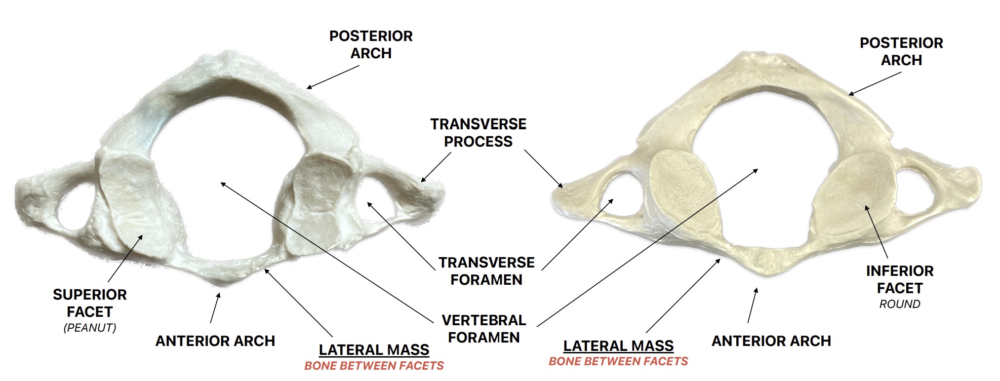 <p>What are these landmarks of:</p><ul><li><p>Superior facet - kidney shaped concave surface</p></li><li><p>Inferior facet - circular concave surface</p></li><li><p>Transverse foramen - hole of wing tip</p></li><li><p>Transverse process - wing tip</p></li></ul><ul><li><p>Lateral mass - in between anterior arch and facet</p></li></ul><ul><li><p><span style="color: yellow;"><strong>Anterior arch - little connecting arch</strong></span></p></li><li><p><span style="color: yellow;"><strong>Posterior arch - big connecting arch</strong></span></p></li><li><p>Vertebral foramen - big hole</p></li></ul><p></p>