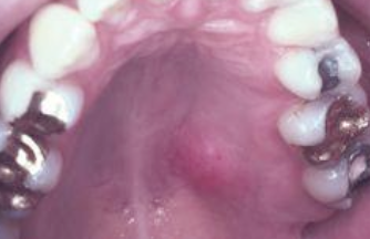 <p>What is the management of Necrotizing Sialometaplasia?</p>