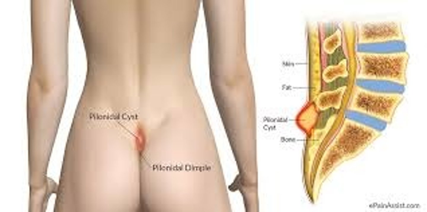 <p>Congenital cyst formation (part of newborn exam)</p>