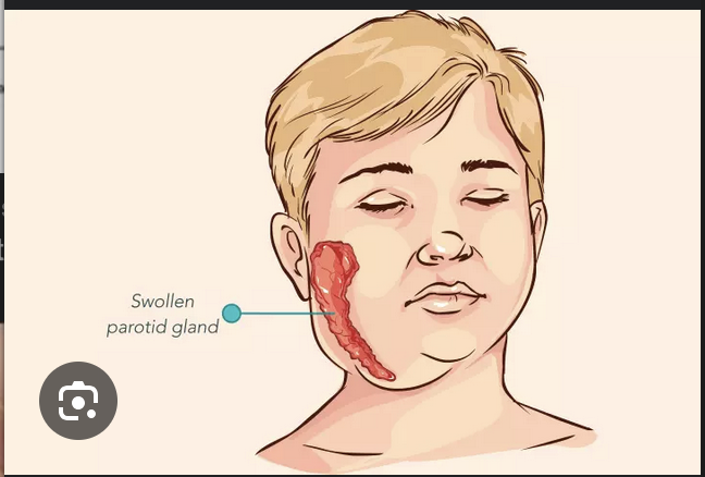 <p><strong>Parotitis </strong>is the <strong>most common feature</strong> of what diseases</p>