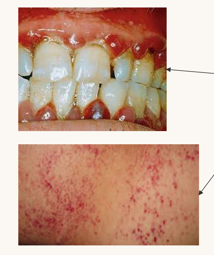 <p>what is this condition and what vitamins is this person likely deficient in?</p>