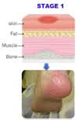 <p></p><p>Non-blanchable red area; intact skin that may feel warm or firm.</p>