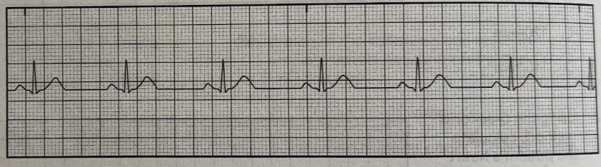 <p>Using the EKG tracing, determine the duration of the QT interval.</p><p>A. 0.25 sec</p><p>B. 0.3 sec</p><p>C. 0.35 sec</p><p>D. 0.4 sec</p>