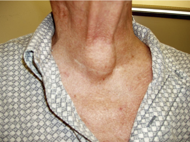 <p>What symptom is this from what disease</p>