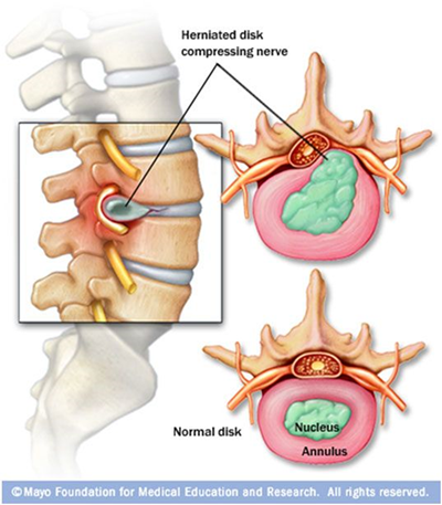 <ul><li><p>Occurs when fibrocartilage of intervertebral discs stressed or cracked</p></li><li><p>Inner, pulp like center protrudes out, causing pressure on spinal cord or nerve</p></li></ul><p></p>