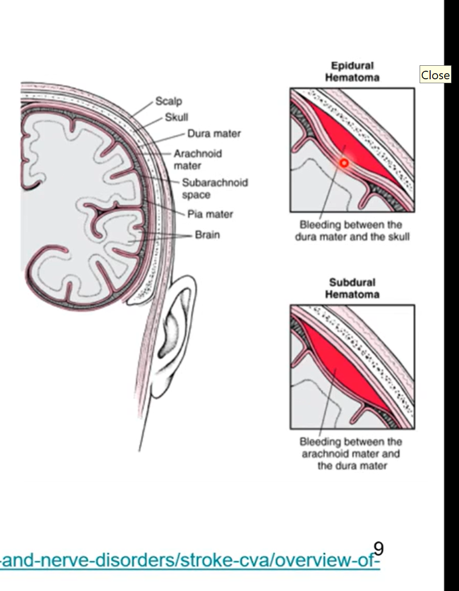 <ul><li><p>3 spaces</p><ul><li><p>subarachnoid </p><ul><li><p>actual space- contains cerebral spinal fluid, arteries, and veins. healthy space</p></li></ul></li><li><p>epidural space</p><ul><li><p>occurs with some sort of injury</p></li><li><p>potential space- observed with injury </p><ul><li><p>hematoma - blood leak from vessel in brain </p></li></ul></li></ul></li><li><p>Subdural</p><ul><li><p>potential space with injury</p></li></ul></li></ul></li></ul><p></p>