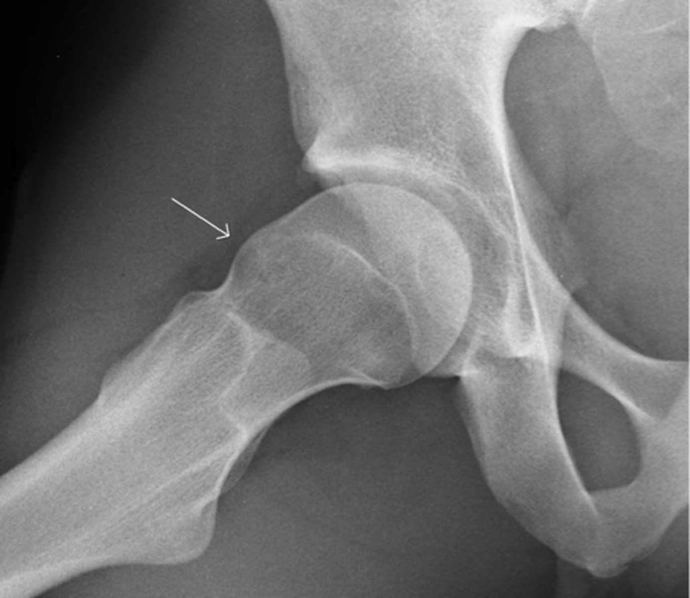 <p>What are the types of femoroacetabular impingement?</p>