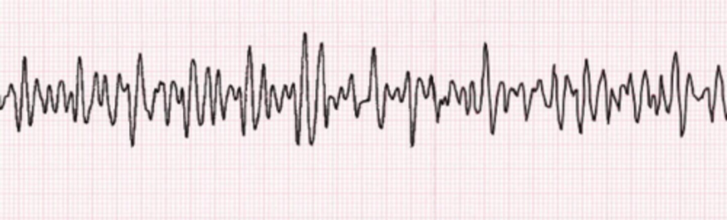 <p>Electrocution</p><p>The rhythm is ventricular fibrillation. Precipitating causes of ventricular fibrillation include electrocution, myocardial ischemia or infarction, shock, stimulant overdose and ventricular tachycardia.</p>