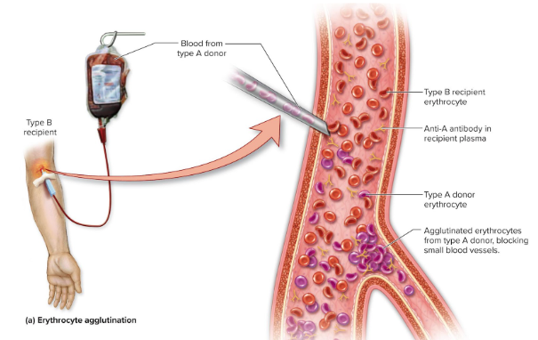<p>someone receives an<strong> incompatible transfusion</strong></p><ul><li><p>Recipient’s <strong>antibodies bind to transfused erythrocytes</strong> and <strong>clump </strong>them together</p></li><li><p>Can block blood vessels, prevent normal circulation, can cause <strong>hemolysis</strong>, <strong>rupture </strong>of <strong>erythrocytes</strong>, <strong>organ damage</strong></p></li></ul><p></p>