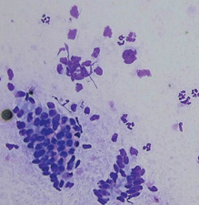 <p>AKP store husdyr blok 1 2024</p><p>Du udtager en svaberprøve fra uterus på en hoppe. Du skanner hoppen, og hun står med intrauterin væske (3 cm) og er i østrus. Dyrkning fra svaberen er steril. Dit cytologiske præparat er afbilledet nedenfor. Hvordan vil du tolke resultaterne fra svaberprøven og din skanning?</p><p>1 Cytologi er negativ (ingen inflammationsceller) og hoppen er derfor klar til inseminering </p><p>2 Cytologi er positiv (inflammationsceller), men da der ikke er vækst af patogener, er hoppen klar til inseminering </p><p>3 Cytologi er positiv (inflammationsceller). Selvom dyrkningen er negativ, er hoppen ikke klar til inseminering </p><p>4 Cytologi er negativ (ingen inflammationsceller), men da hoppen står med intrauterin væske bør hun behandles inden inseminering</p>