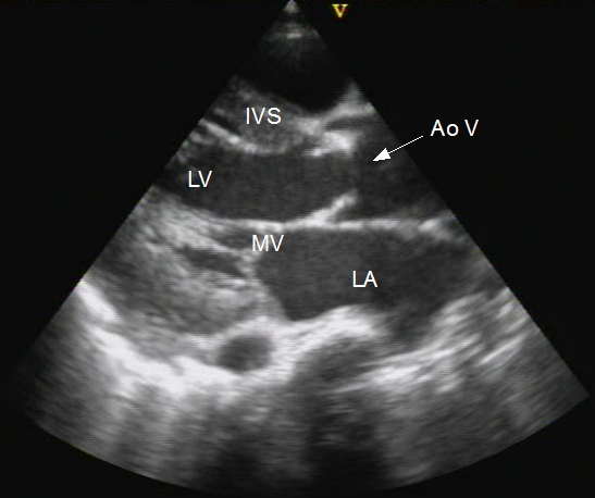 <p>The DA is seen below the LA and helps distinguish between a pericardial effusion and a pleural effusion.</p>
