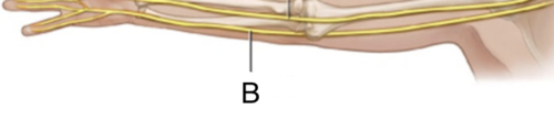 <p><span>Sensory-motor nerve that, with its branches, affects the little-finger side of the arm and palm of the hand.</span></p>