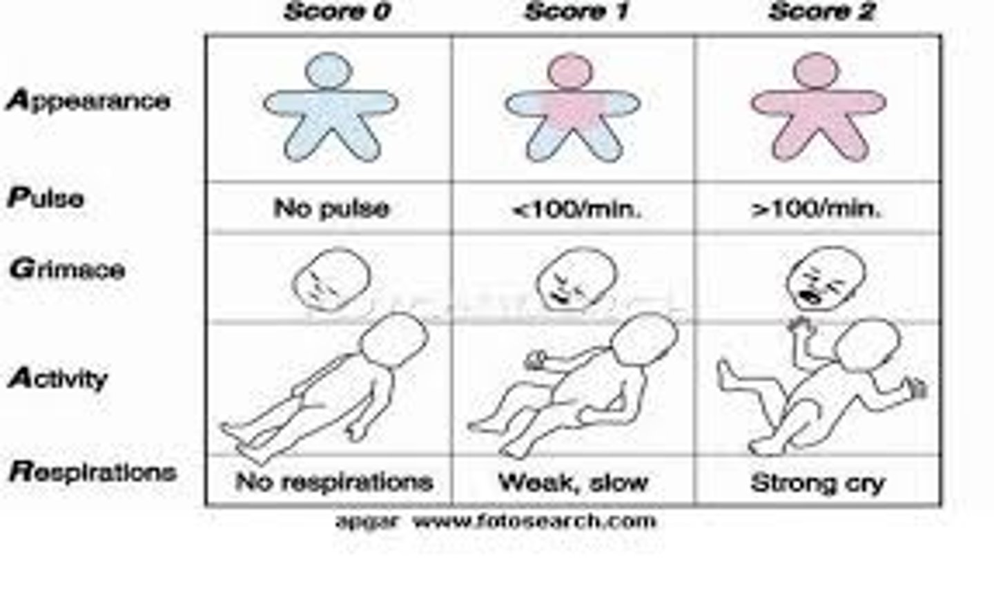 <p>What: standard measure for infant assessment at 1 min and 5 min post birth (sometimes 10 min)</p><p>Scoring:</p><p>-low= not good</p><p>-high= better</p><p>-7/10 is normal baby</p><p>Appearance:</p><p>-0= Blue</p><p>-1= blue extremities by normal core</p><p>-2= no blue</p><p>Pulse:</p><p>-0= Absent</p><p>-1= <100 bpm</p><p>-2= 100-140 bpm</p><p>Grimace (reflex irritability):</p><p>-0= No response</p><p>-1= Grimace</p><p>-2= Cry and/or withdrawal</p><p>Activity (muscle tone):</p><p>-0= Flaccid</p><p>-1= Some flexion</p><p>-2= Active motion of extremities</p><p>Respiration:</p><p>-0= Absent</p><p>-1= Weak cry and hypoventilation</p><p>-2= Strong loud cry</p>