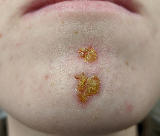<ul><li><p>Erythematous macule </p></li><li><p>Superficial erosion with golden crust </p></li><li><p>Sores (non-bullous) </p></li><li><p>Blisters (bullous)</p></li></ul><p></p>