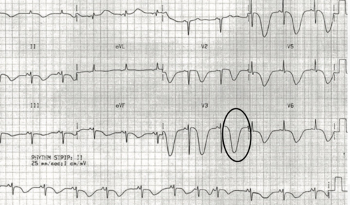 <p>- widespread giant T wave inversions known as "cerebral T waves"</p><p>- prolonged QT interval</p><p>- bradycardia</p>