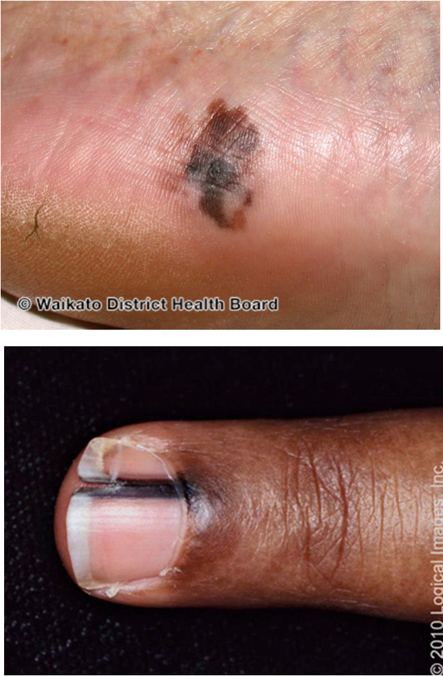 <ul><li><p>MC type of melanoma seen in Fitzpatrick III and above</p></li><li><p>arises most commonly on palmar, plantar, subungual, and mucosal surfaces</p></li><li><p>dark brown/black, irregularly pigmented macules or patches w/ raised areas, ulceration, bleeding</p></li><li><p>occasionally can present as amelanotic/hypomelanotic lesions</p></li><li><p>slow growing- can take mos-yrs</p></li><li><p>hutchinson’s sign- involvement of proximal nail fold</p></li></ul><p></p>
