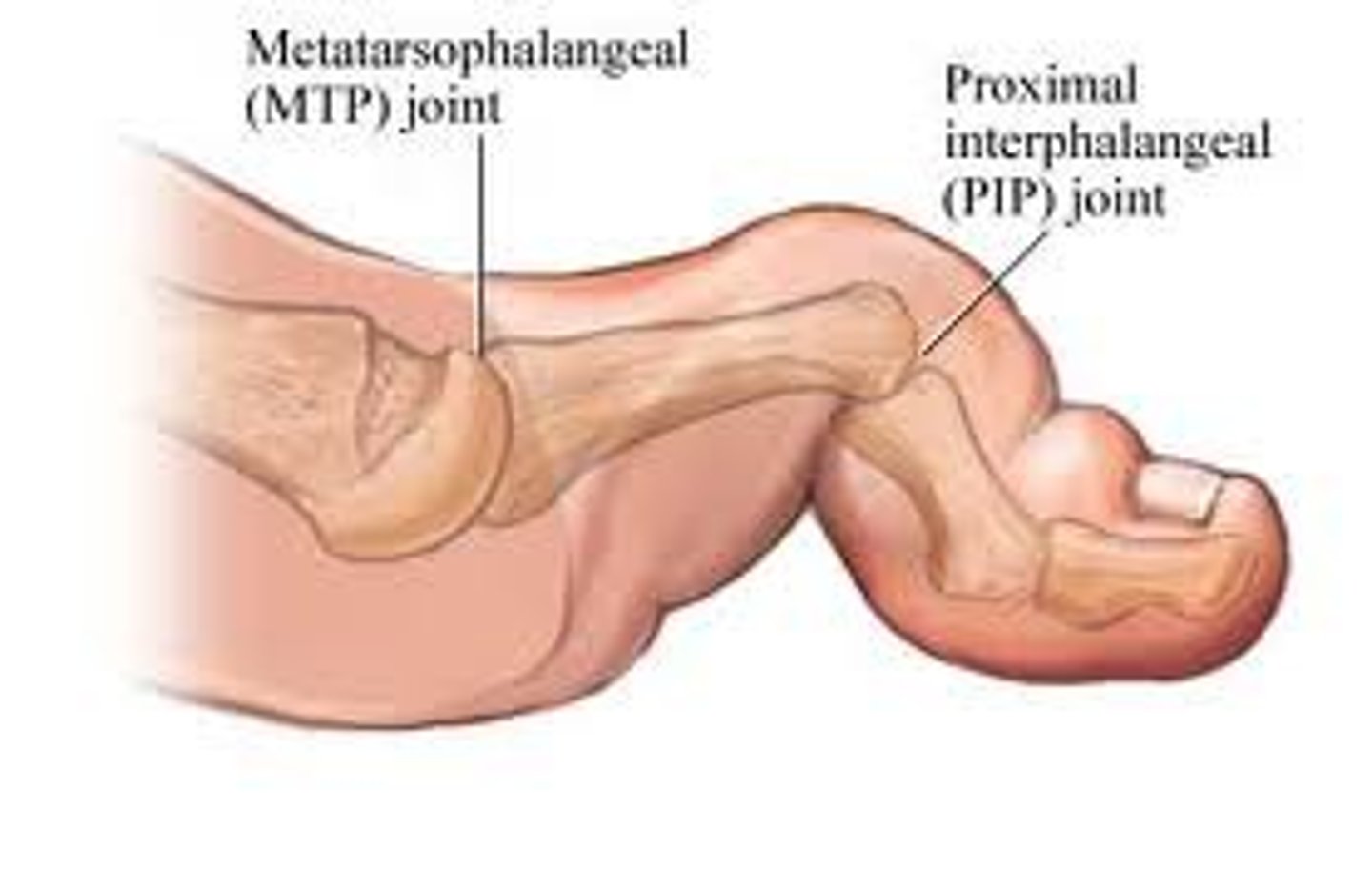 <p>PIP joint will be flexed</p><p>- typically affects only one toe (usually the 2nd)</p>