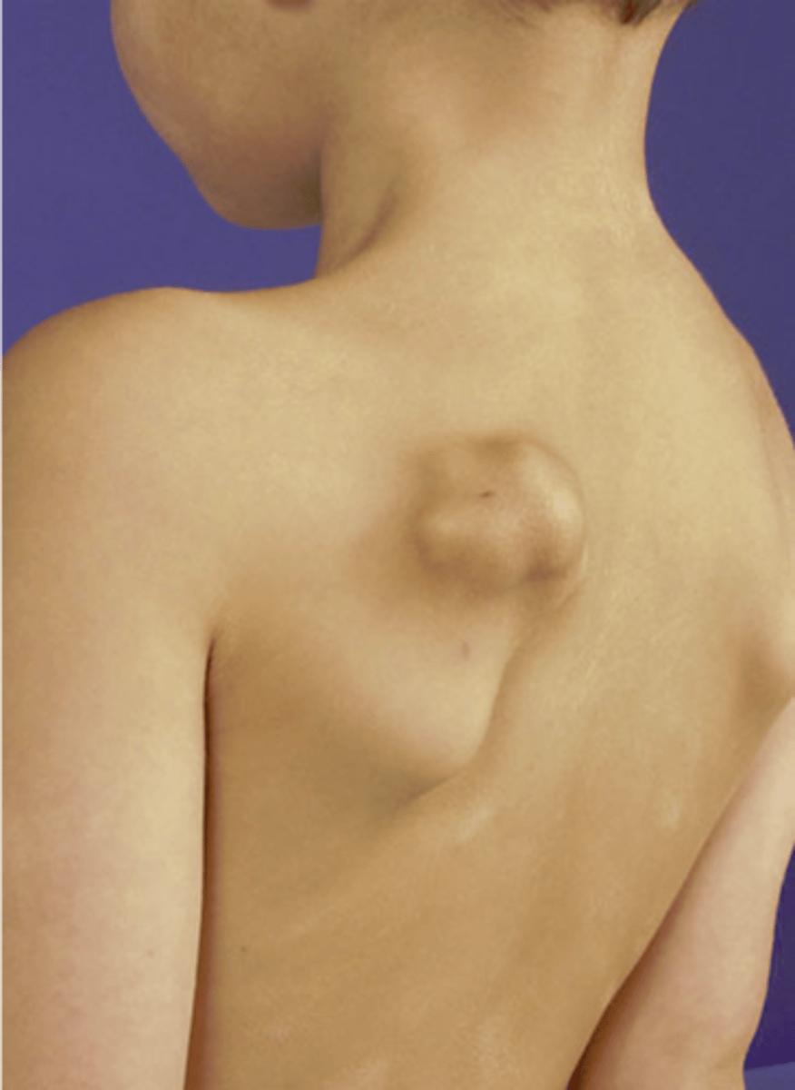 <p>- Most common benign skeletal growth or tumor</p><p>- 50% of all benign bone tumors</p><p>- 10-15% of all primary bone tumors</p><p>- 75% &lt;20 y.o.</p><p>- M:F, 2:1</p><p>- Malignant transformation &lt;1%</p>