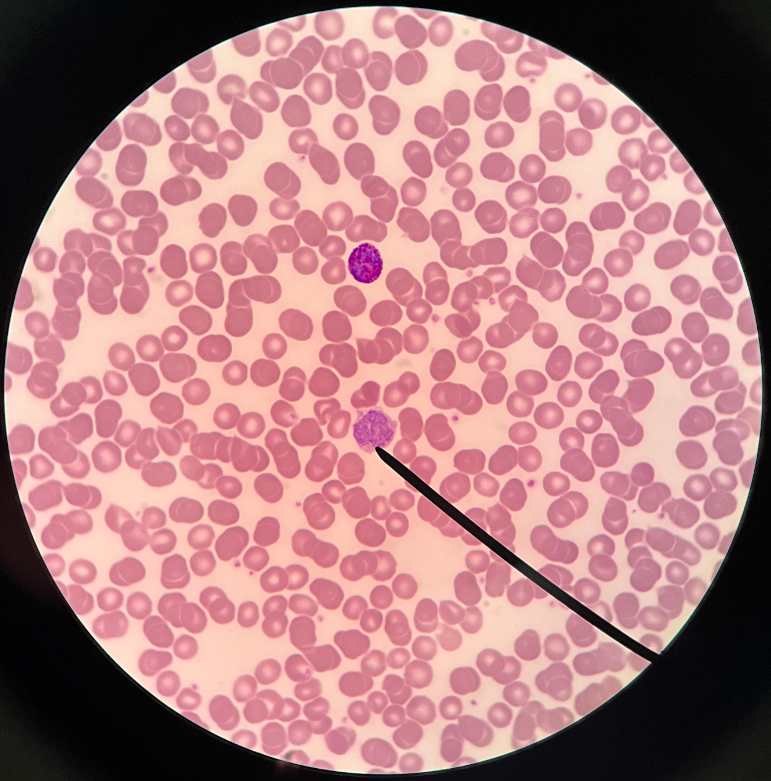 • Leukocyte and agranulocyte.

• Appears with a horseshoe-shaped nucleus and much cytoplasm; about twice the size of an erythrocyte.

• The largest leukocyte.

• Migrates out of the bloodstream and enters tissues as macrophages. Particularly appears in the lung, spleen, liver, and lymph nodes.

• Count increased by bacterial, viral, and fungal infections; or leukemia.

• Count decreased by chronic illness or anti-inflammatory treatments.